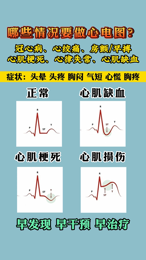 哪些情况，需要做心电图？