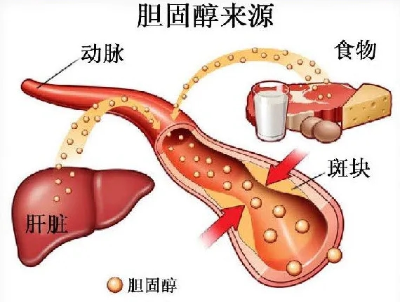 “胆固醇大户”被揪出，医生建议：这4种食物千万要少吃