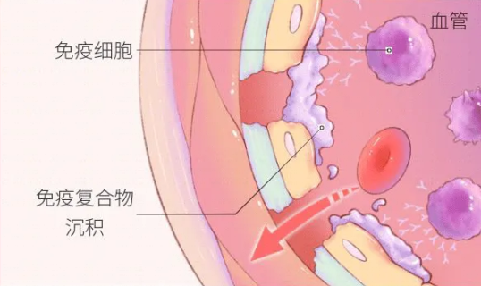 过敏性紫癜的检查方法