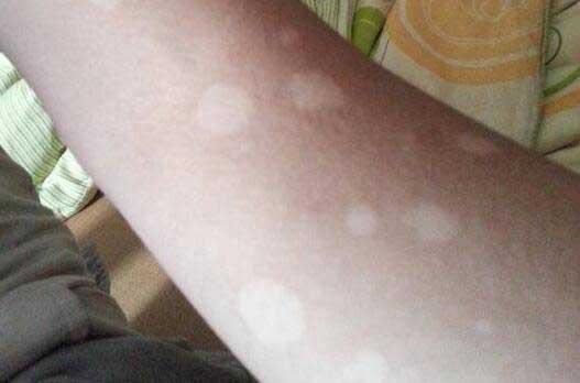 白癜风初期症状是怎样的