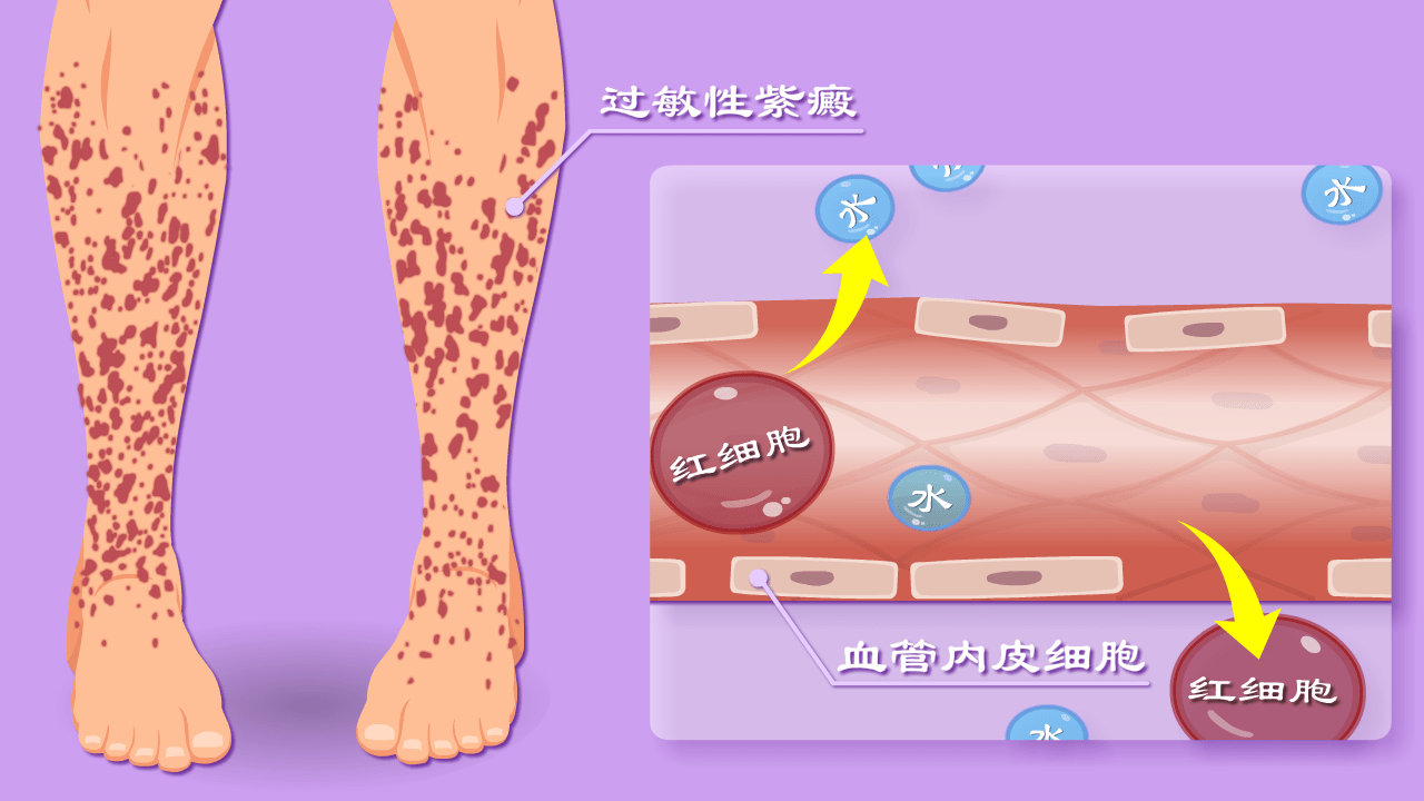 专家详解：如何判断过敏性紫癜的病情严重程度？