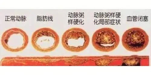 斑块的形成和发展过程？如何判断斑块的“软”与“硬”？