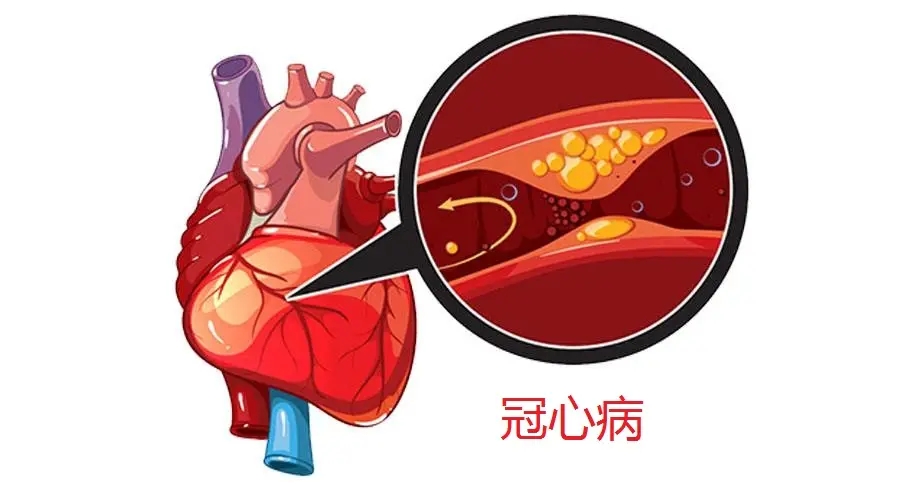 冠脉狭窄多少才算是冠心病？4个方面，做好预防！