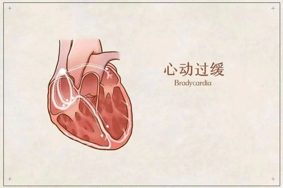 心跳＜60次/分，是心动过缓吗？