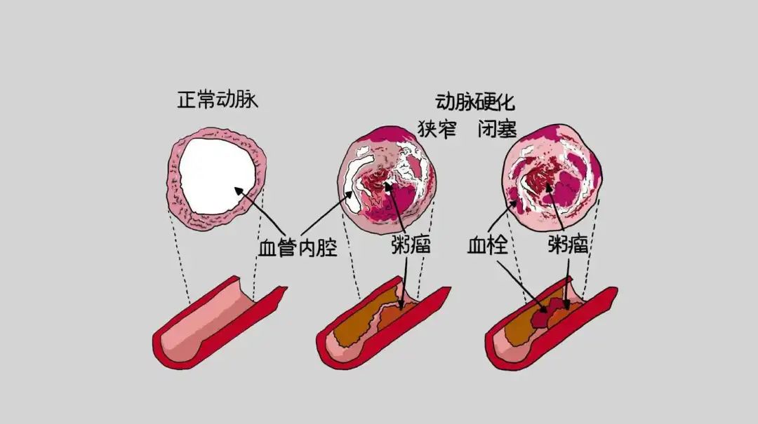医生：动脉硬化发展分为4个阶段，早发现、早预防！