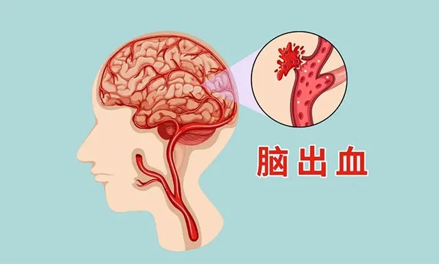 秋冬季脑出血高发，做好