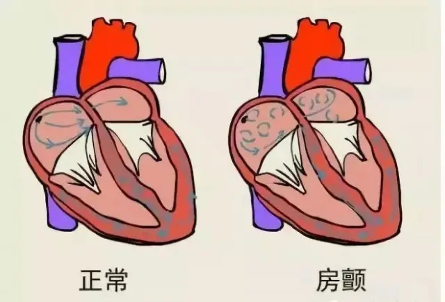 “健康杀手”房颤，中医治疗配合护理，恢复正常心率
