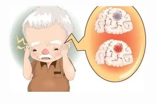 有没有脑梗，看看这3个部位，早发现、早预防！