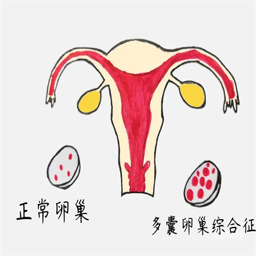 爆痘、长胖还不孕？小心多囊卵巢综合征！