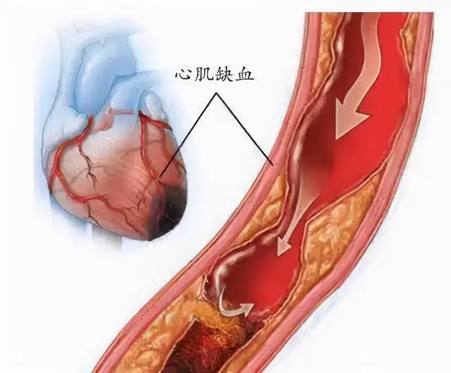 心肌缺血拖不得，出现5大症状，抓紧中医调治！