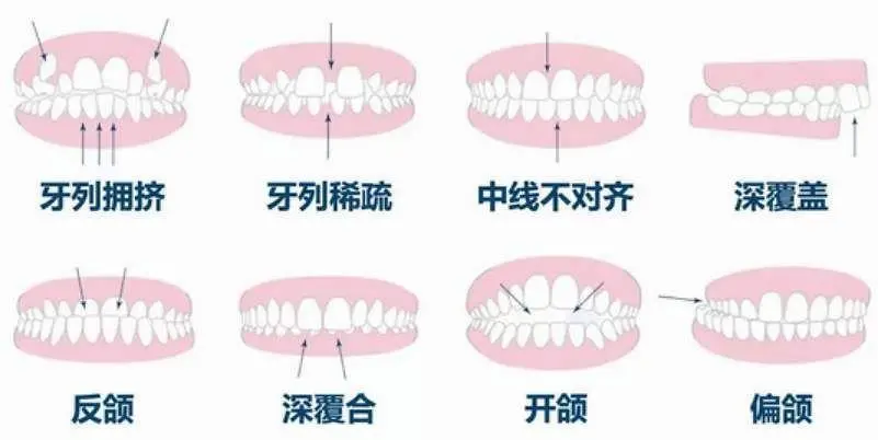 牙齿正畸7K能做吗？1W够吗？(成都正畸收费表流出）