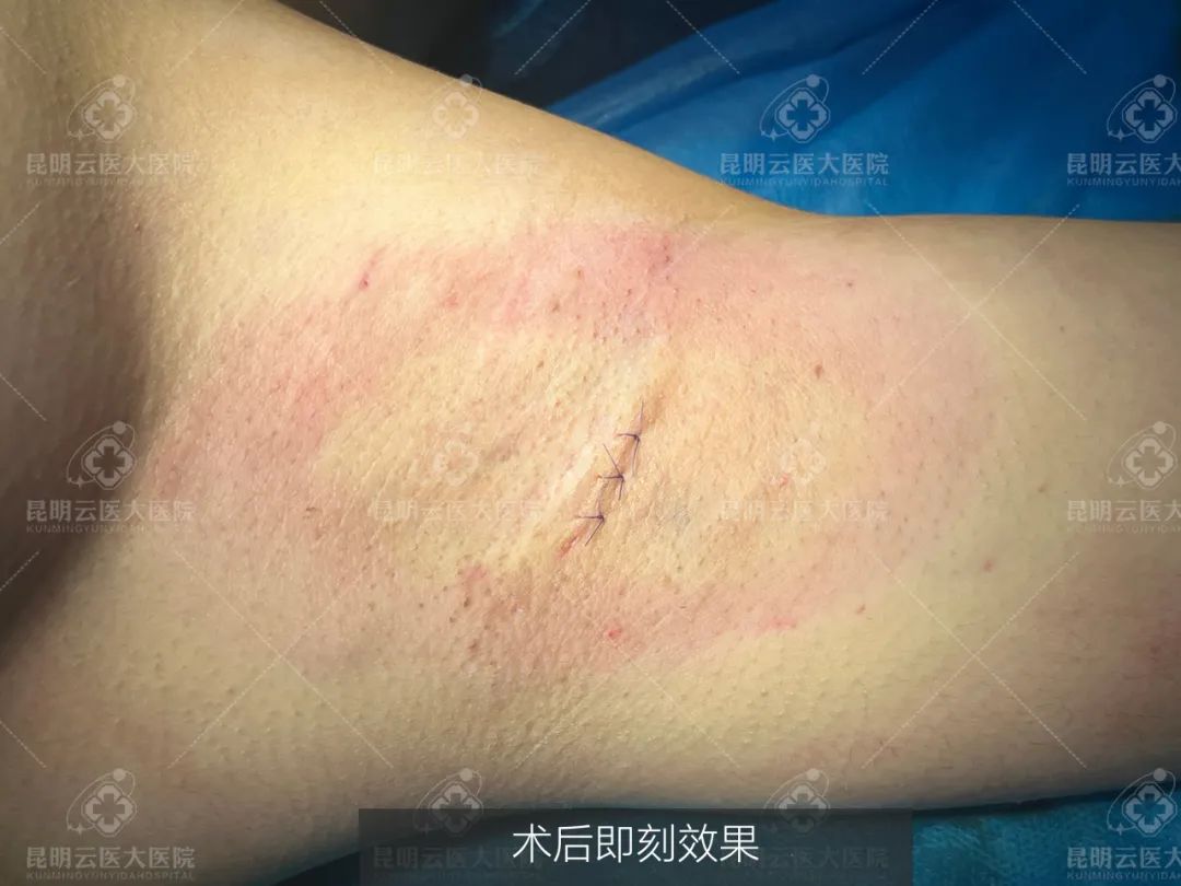 3D可视超微创腋臭手术——根除腋臭的最优选项！