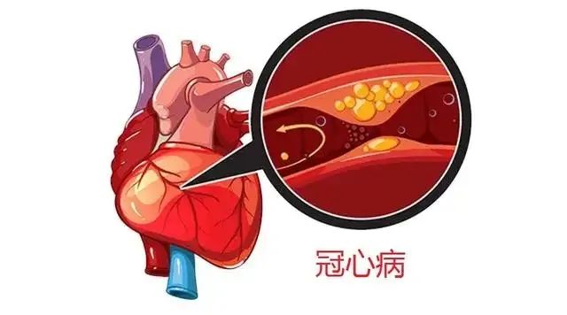 心血管医生：冠心病有5大类型