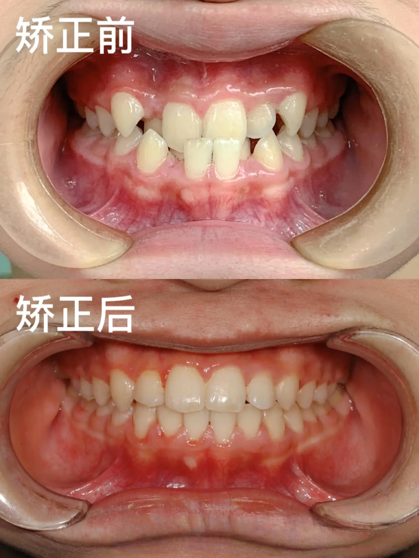 牙齿矫正