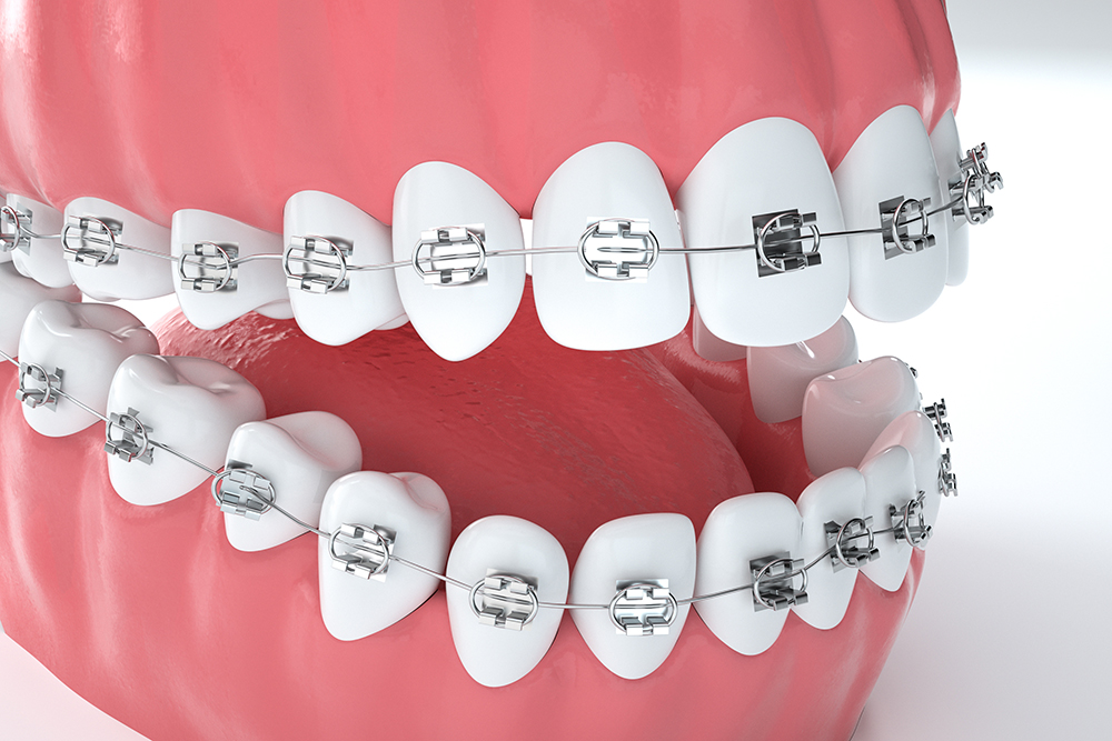 牙齿矫正