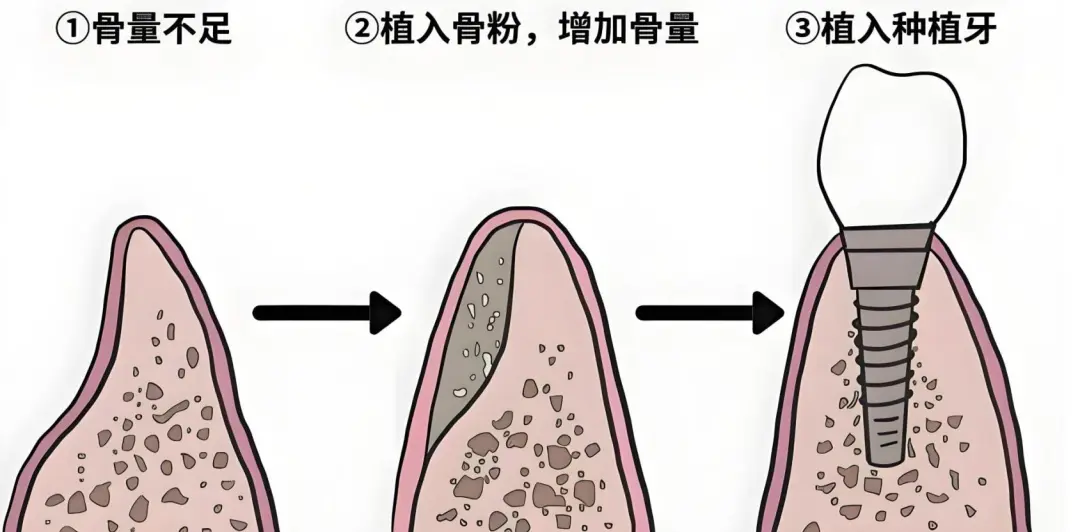 种植牙想种就种？医生为啥让我先植骨？