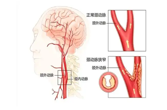 颈动脉斑块治疗方法  北京哪家医院治疗颈动脉斑块好？