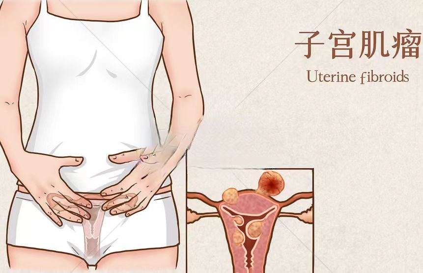 不胖为什么会有小肚子？女性朋友要当心这两种妇科疾病~