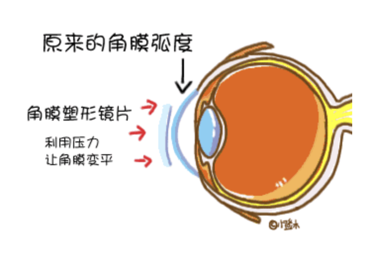 ICL晶体植入术：高度近视的光学矫正新选择
