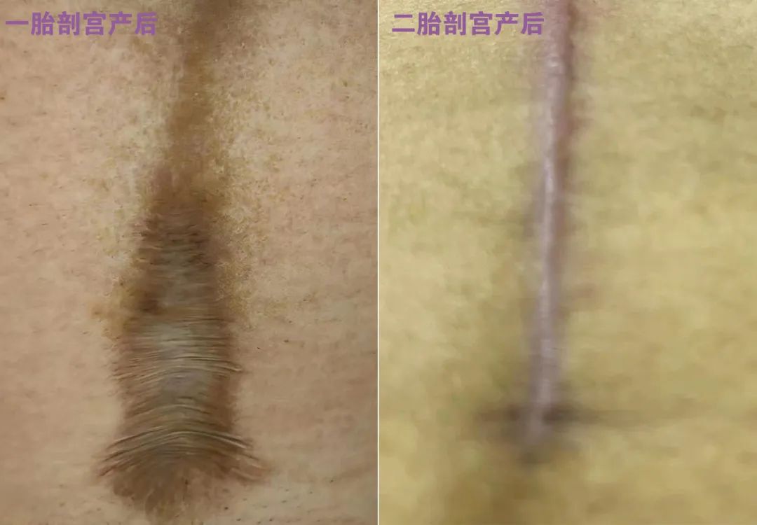 为了祛疤拼二胎？一位剖宫产妈妈的“祛疤”故事