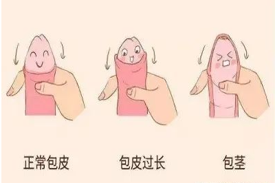 【包皮过长术后常见护理方法？】—漳州博爱医院男科